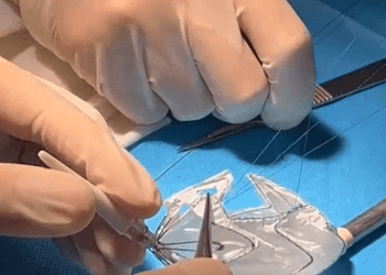 Vinmec áp dụng công nghệ 3D hỗ trợ can thiệp tim mạch lần đầu tiên ở Đông Nam Á