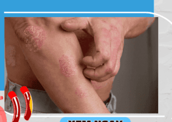 Làm gì để ngăn ngừa biến chứng của vảy nến và giải pháp từ Kim Miễn Khang?