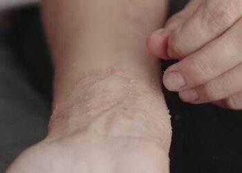 Cải thiện viêm da cơ địa mùa lạnh hiệu quả nhờ kem thảo dược Eczestop